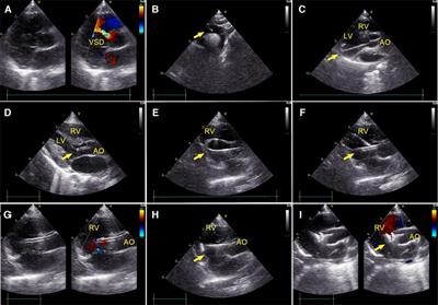 Comparison of perventricular and percutaneous ultrasound-guided device closure of perimembranous ventricular septal defects